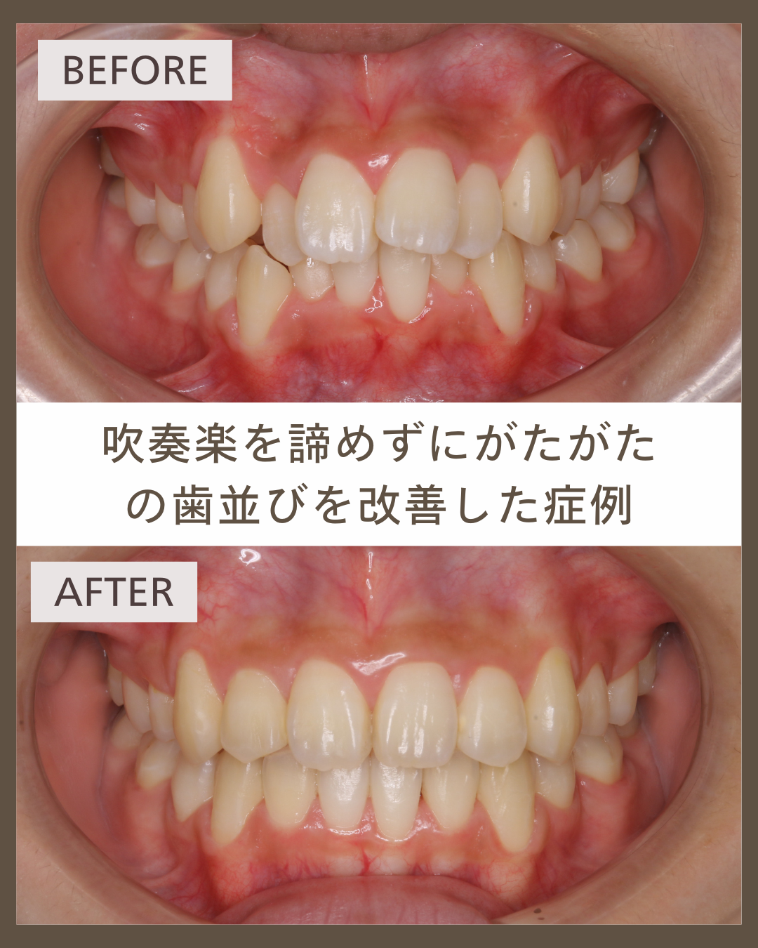 【舌側矯正】吹奏楽部を続けながら歯並びを改善した高校生の症例