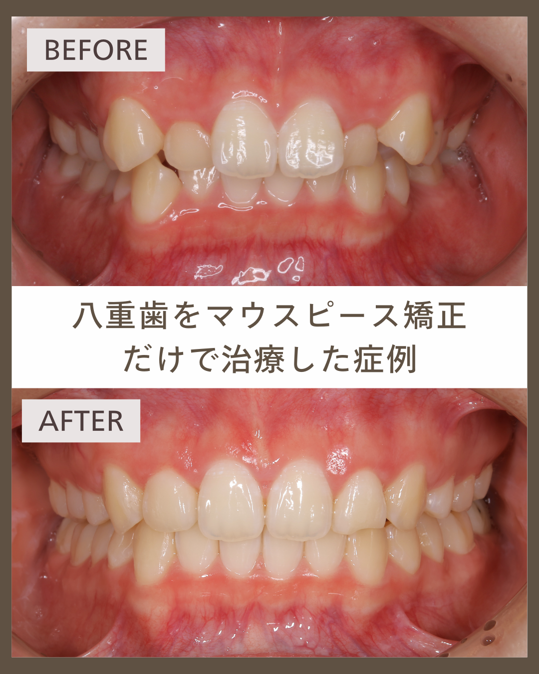 【マウスピース矯正】大学卒業までに1年5か月で歯並びのでこぼこを改善した症例