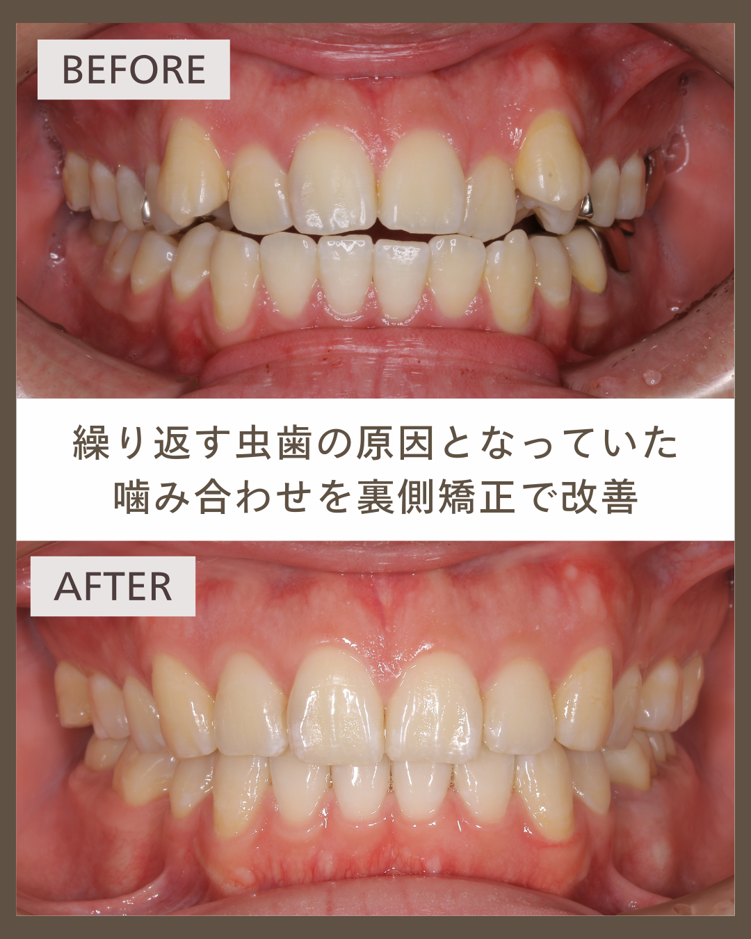 【舌側矯正】虫歯をくり返していた19歳の歯並びと噛み合わせを改善した症例