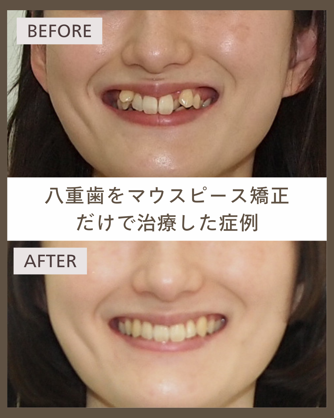 【マウスピース矯正】八重歯と前歯のがたつき…ここまで変化した20代女性の症例