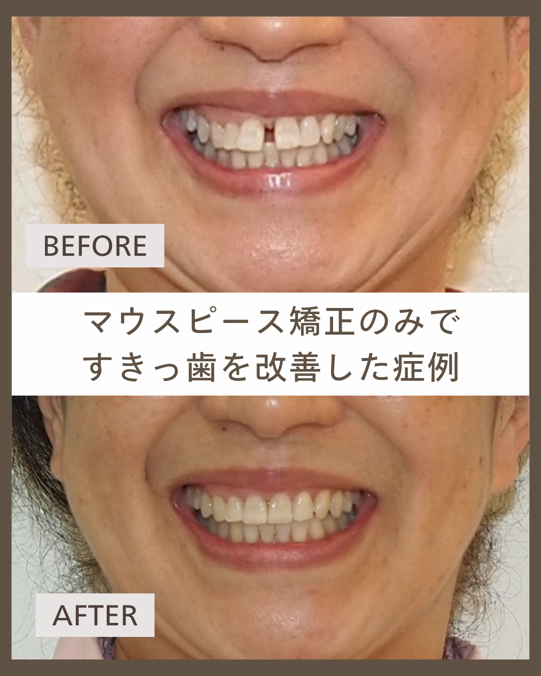 【マウスピース矯正】50代から始める矯正治療。前歯のすき間を改善した症例