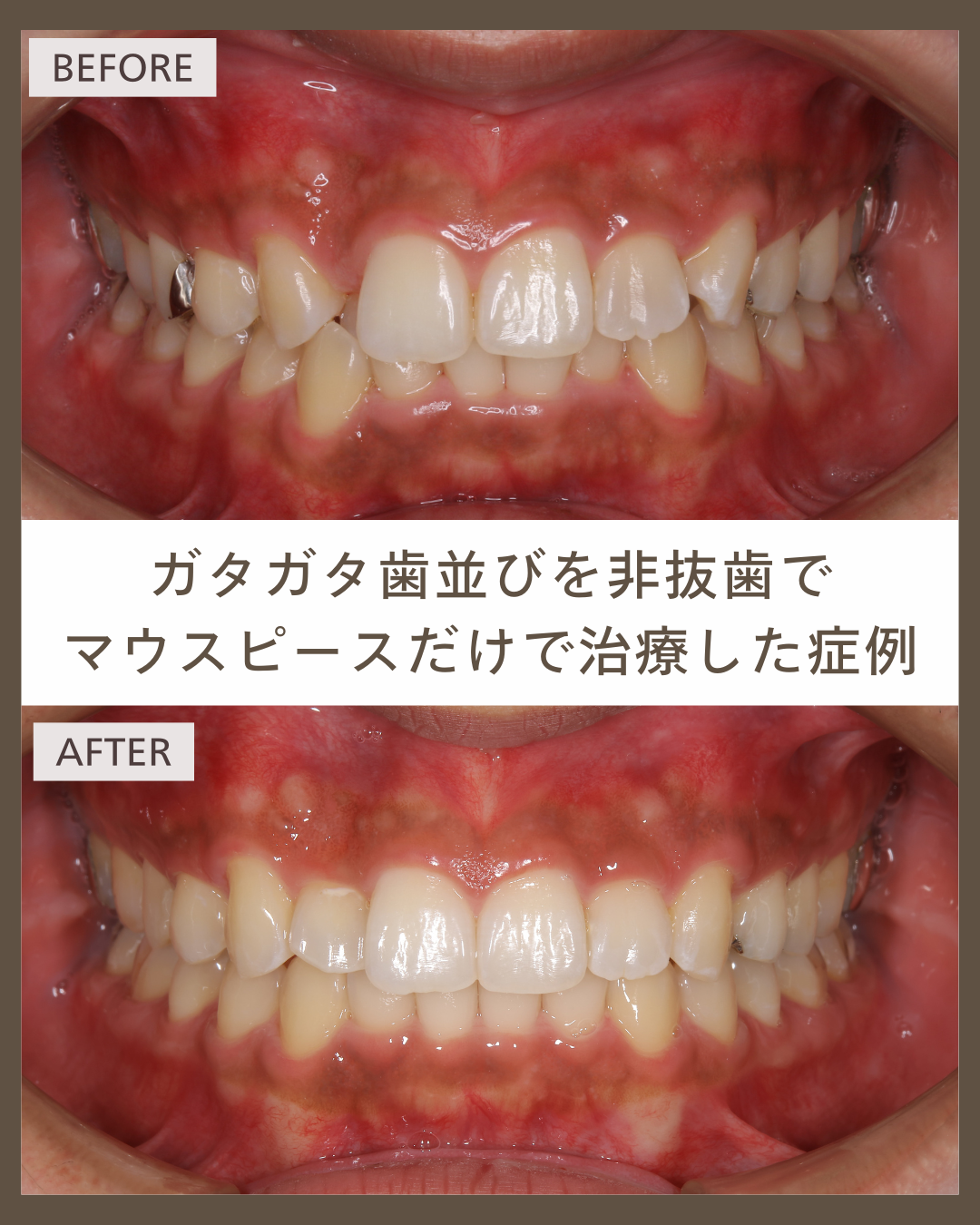 【マウスピース矯正】抜歯せずにガタガタの歯並びを改善した20代男性の症例