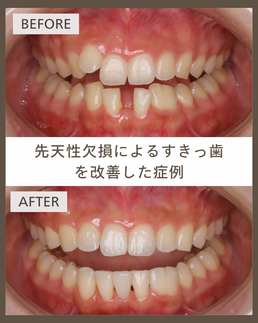 【舌側矯正】先天性欠損によるすきっ歯を改善した20代女性の症例