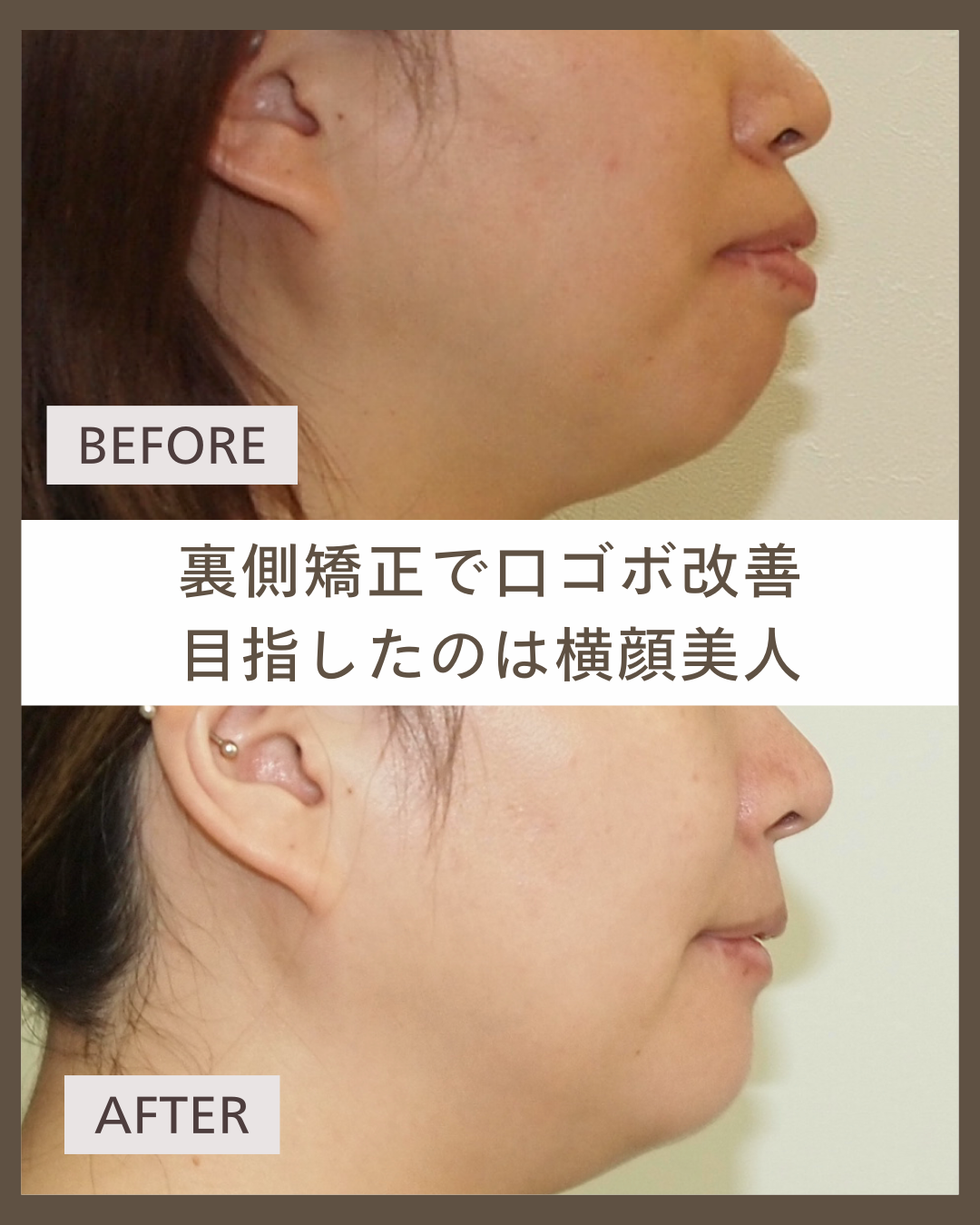 【舌側矯正】口ゴボを改善した30代女性｜Eラインの変化がわかる症例