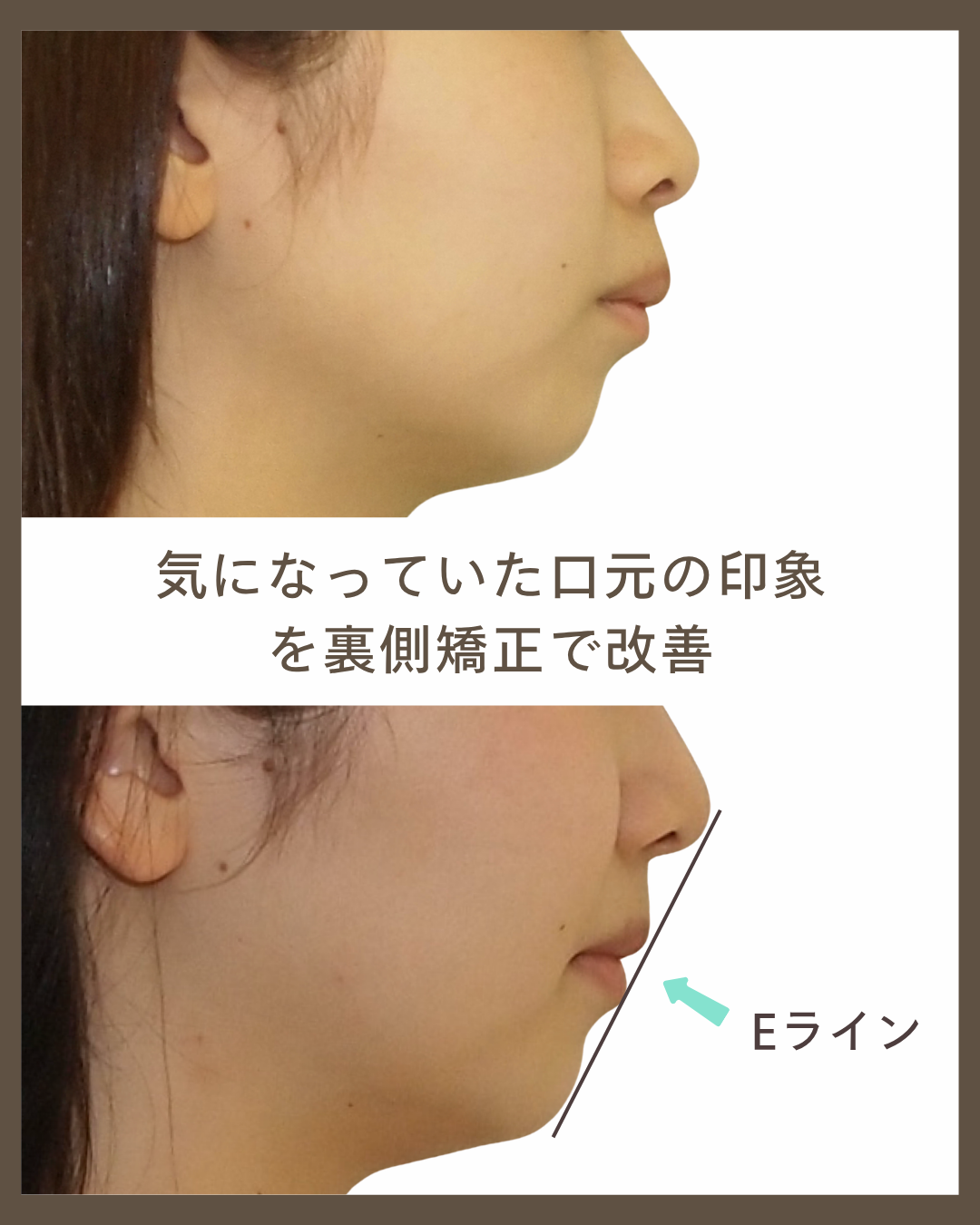 【舌側矯正】Eラインを考慮し、上顎のみ抜歯で出っ歯を改善した大学生の症例