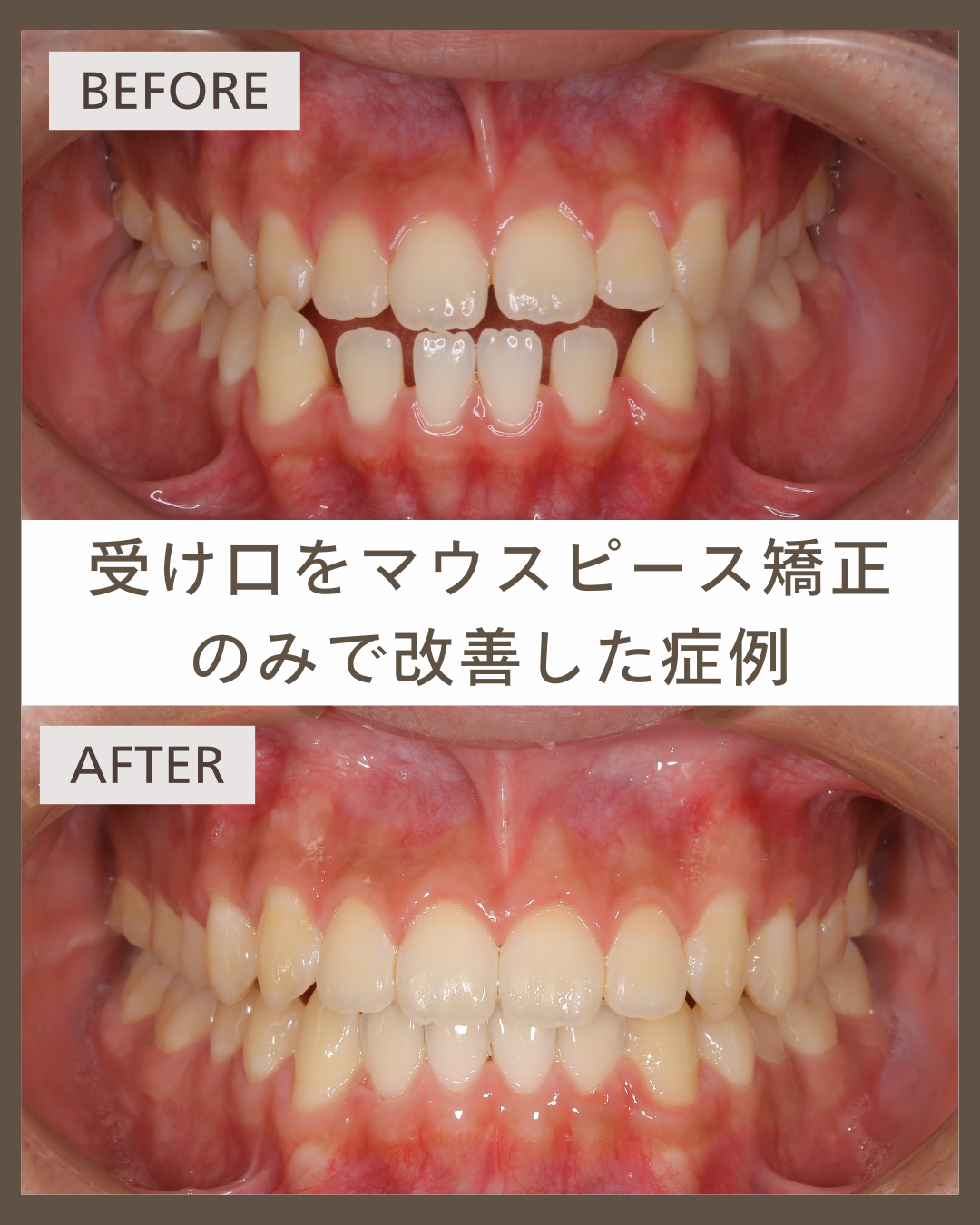 【マウスピース矯正】手術なしで受け口をマウスピース矯正のみで治療した症例